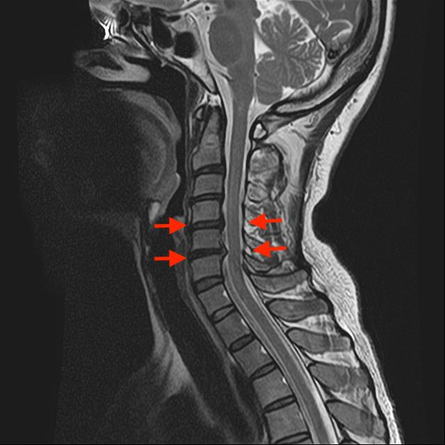頚椎椎間板ヘルニア | 新千歳クリニック